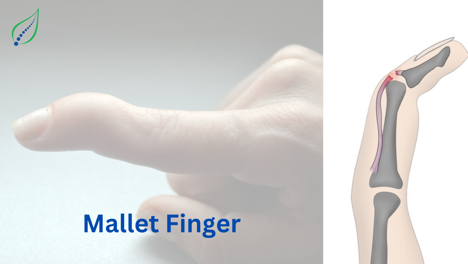 Mallet Finger